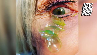 Video shows doctor removing 23 contacts from forgetful woman's eye