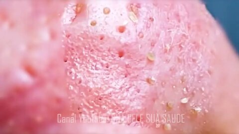 Satisfactory Video Blackhead Removal Skin Cleansing #16 | 2022 Video