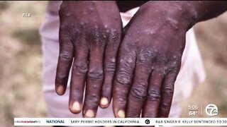 First probable case of Monkeypox found in Oakland County