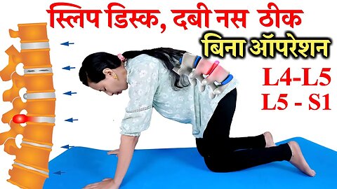 दबी नस स्लिप डिस्क ठीक Without Operation | Slipped Disc Treatment, Slipped Disc Exercises