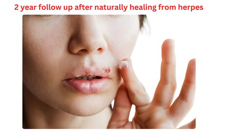 Herpes is still gone after 3 years of naturally healing.