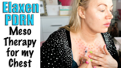 Elaxen PDRN Meso Therapy for my Chest | | Code Jessica10 saves you $$$