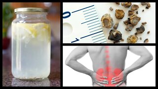 Natural Home Remedies for Kidney Stones