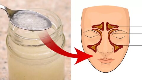 Treat Sinus Infections and Bronchitis Naturally at Home