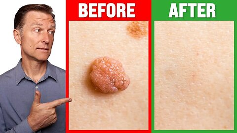 How to Rid Skin Tags and Warts OVERNIGHT