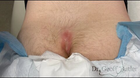 Drainage of an infected pilonidal cyst - GRAPHIC CONTENT