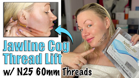 Jawline Cog Thread Lift with N25 60mm Threads from www.acecosm.com | Code Jessica10 Saves you Money!