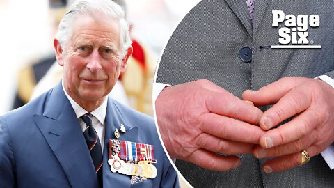 King Charles III's hands turn red and raw amid Wales greetings