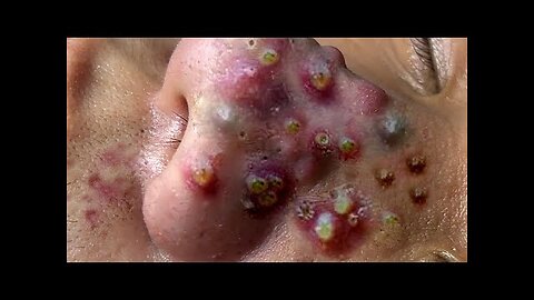 Satisfying blackheads removal Pimple Popper