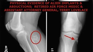Physical Evidence of Alien Implants & Abduction, Retired Assistant Attorney General & Air Force Med