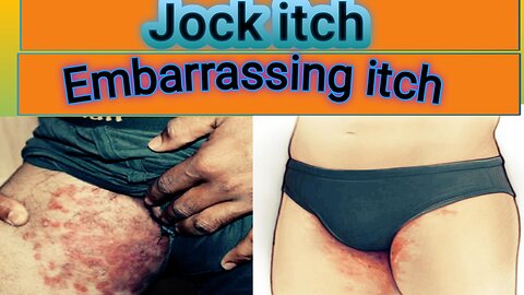 jock itch treatment/ tinea treatment/ringworm treatment/ fungal treatment/groin fungus treatment