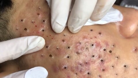 Removing Acne and Blackheads Treatment, #45