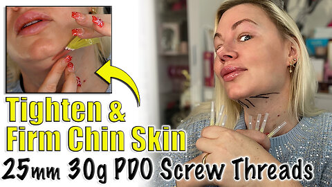 Tighten Chin Skin with 25mm 30g PDO Threads, AceCosm| Code Jessica10 saves you money