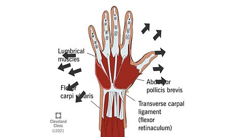 swelling in muscle of hand due arthritis