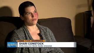 Riverwest woman shares disease that wiped her savings