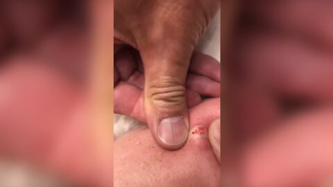Popping huge blackheads and Pimple Popping - Best Pimple Popping