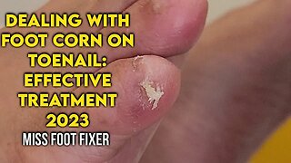 Dealing with Foot Corn on Toenail: Effective Treatment by famous podiatrist miss foot fixer