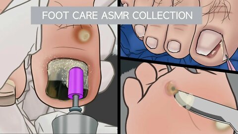 ASMR Foot Care Animation Collection | bruised toenail | Ingrown Toenail | corn removal