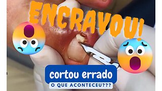 Removendo a unha encravada em segundos #ingrown_toenail #unhaencravada #podologia