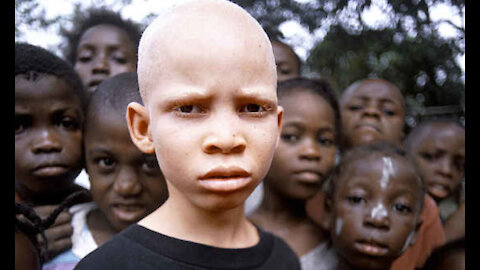 Alfred Speaks On The Upsurge Of The Ritual Killing Of Albinos In Tanzania