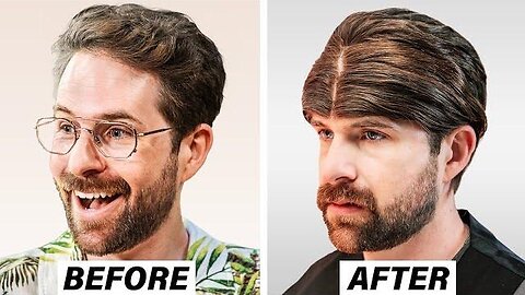 I Regret My Turkish Hair Transplant