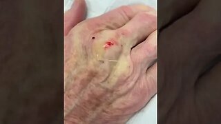 Doctor shows wild cyst drainage! #cyst #pimplepop #dermreacts