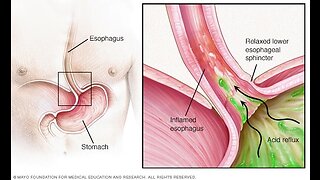 How to Prevent Acid Reflux, Heartburn Causes, and Acidic Foods to Avoid