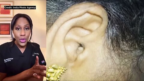 Spider Crawls Out of Ear 🕷: Doctor Reacts