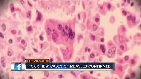 4 more cases of measles reported in Pinellas County, total now stands at 7
