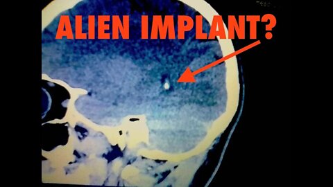 Disclosure, Is This an Alien Implant in the Brain - Purpose of ET Technology