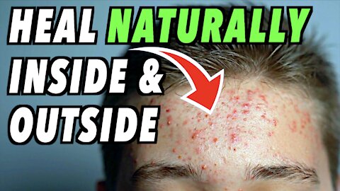 BEST All Natural Home Remedies to Clear Up Adult Acne WITHOUT MEDICATION!!