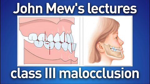 John Mew's lectures - part 21: Class III malocclusion