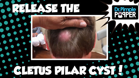 Release the Cletus Pilar Cyst!!