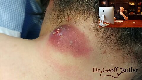Dr. Butler Reacts (Full Video) | Drainage of Infected Epidermal Cyst