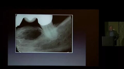 The Diagnosis and Successful Treatment of Jawbone Osteonecrosis | Stuart Nunnally, DDS, FIAOMT