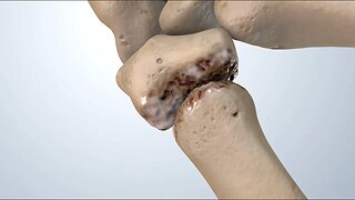 Comprender la osteoartritis del pulgar