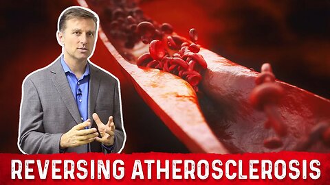 What causes Atherosclerosis & How to Reverse Hardening of the Arteries – Dr.Berg