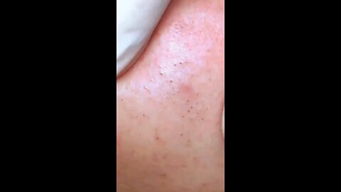 Blackheads episode 78