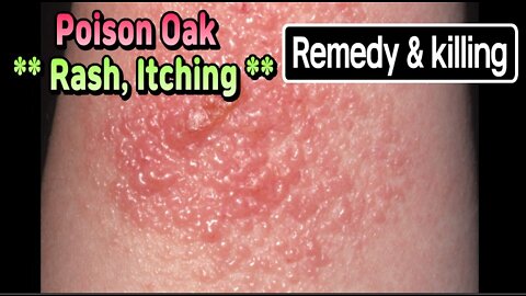 Poison Oak rash, itching, remedy and killing.