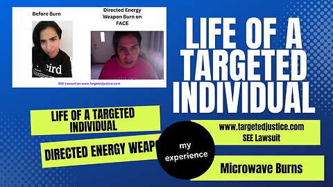 Directed Energy Weapon DEW Targeted Individual burn story day5