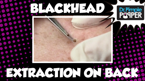 Blackhead extractions on the back, plus...