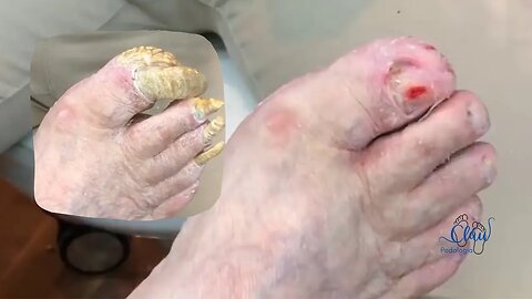 Unhas grandes, pés idosa de 80 anos! #unhas #pes #dor #podologia #idosos #unhasgrandes #cortes