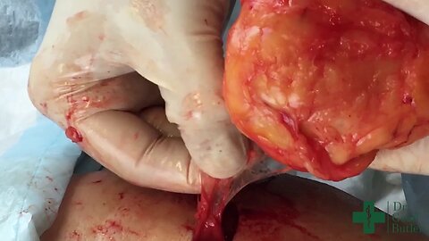 Removal of a Gigantic Lipoma on the Abdomen