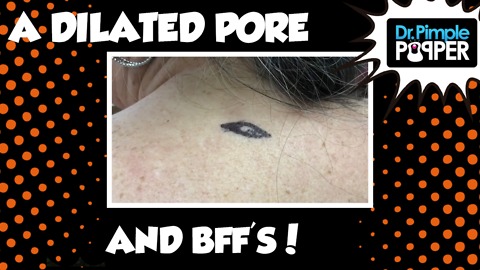 A Dilated Pore and BFF's!