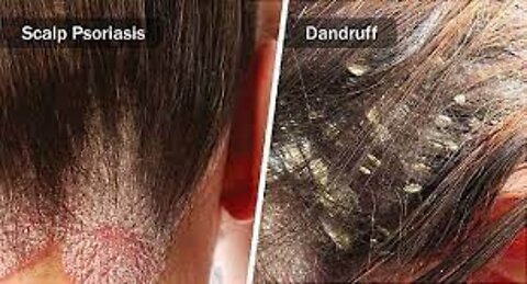 How To Cure Dry Scalp, Dandruff And Psoriasis