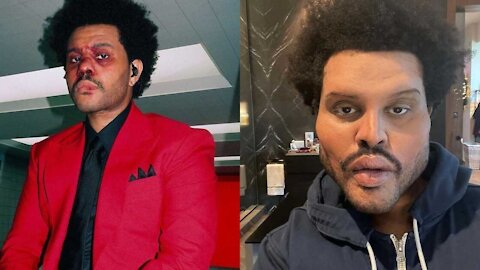 The Weeknd Finally Revealed What Is Going On With His Face