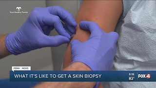 Your Healthy Family: What it's like to get a skin biopsy