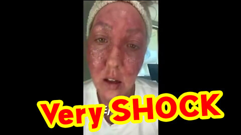 Bombshell! Vaccine Damaged Face - Pimple Medicine Ain't Gonna Help This