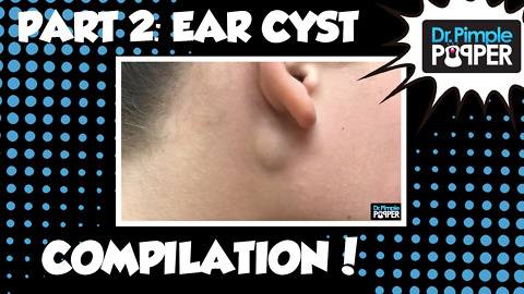 Ear Ya GO! Ear Cyst Compilation Part 2