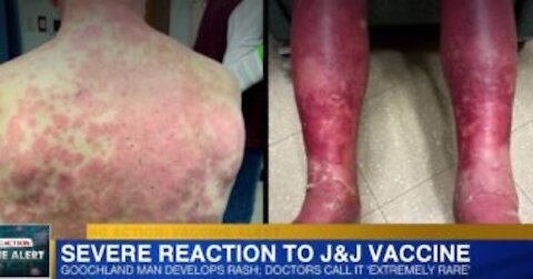 Man Has Rare, Horrifying Reaction to Johnson & Johnson COVID Vaccine!